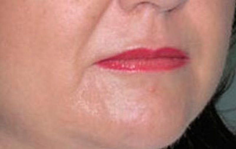 BOTOX Before & After Gallery - Patient 399399 - Image 3
