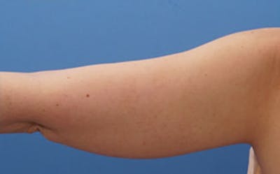 BodyTite Before & After Gallery - Patient 195343 - Image 1