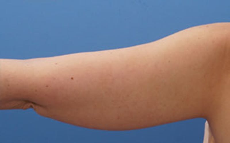 Patient f_C0pDw3SqelcEklzpOz4Q - Arm Lift Before & After Photos