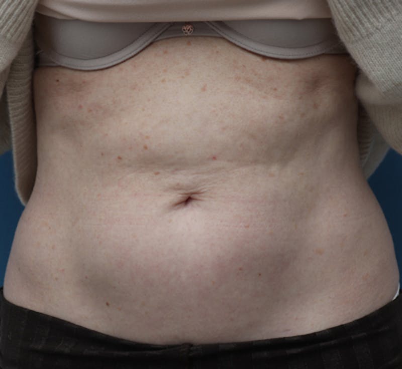 Liposuction (Body) Before & After Gallery - Patient 352394 - Image 10
