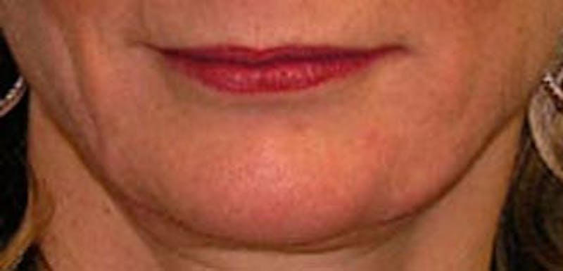 Jawline Contouring Before & After Gallery - Patient 354360 - Image 1