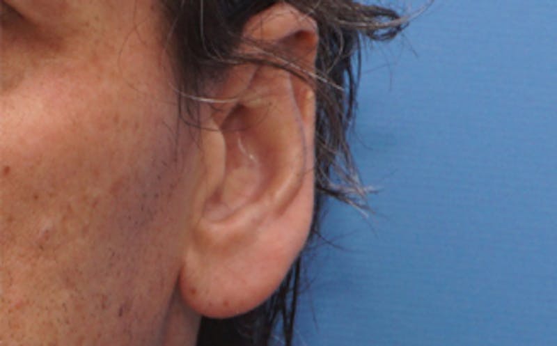 Ear Surgery Before & After Gallery - Patient 113025 - Image 5