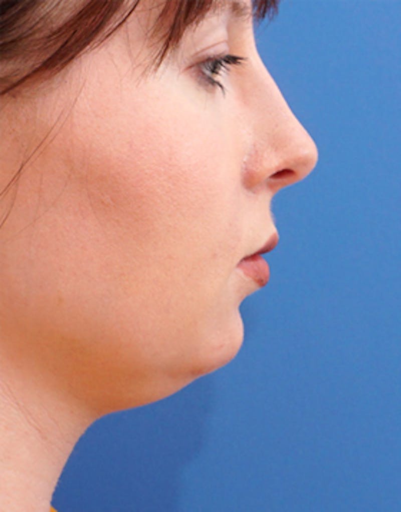 Neck Liposuction Before & After Gallery - Patient 301338 - Image 1