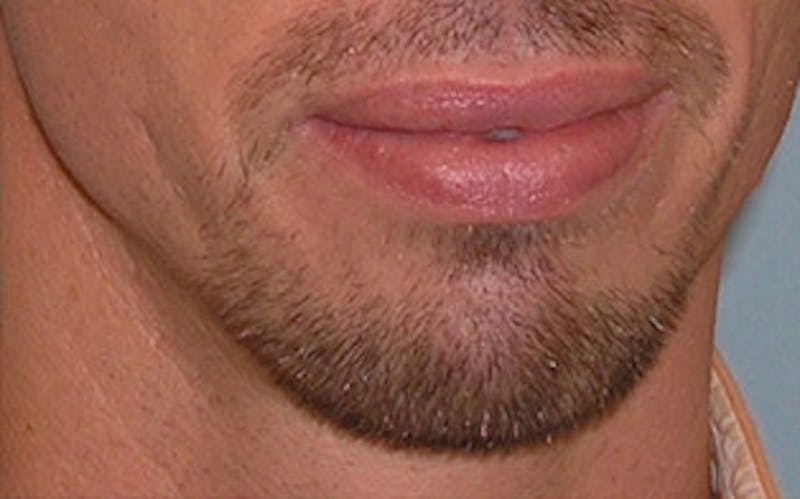 Chin Surgery Before & After Gallery - Patient 346731 - Image 7