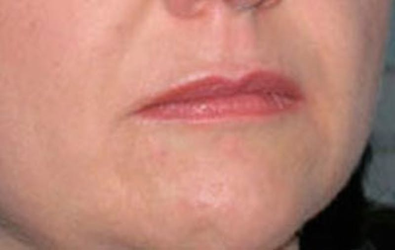 BOTOX Before & After Gallery - Patient 399399 - Image 4