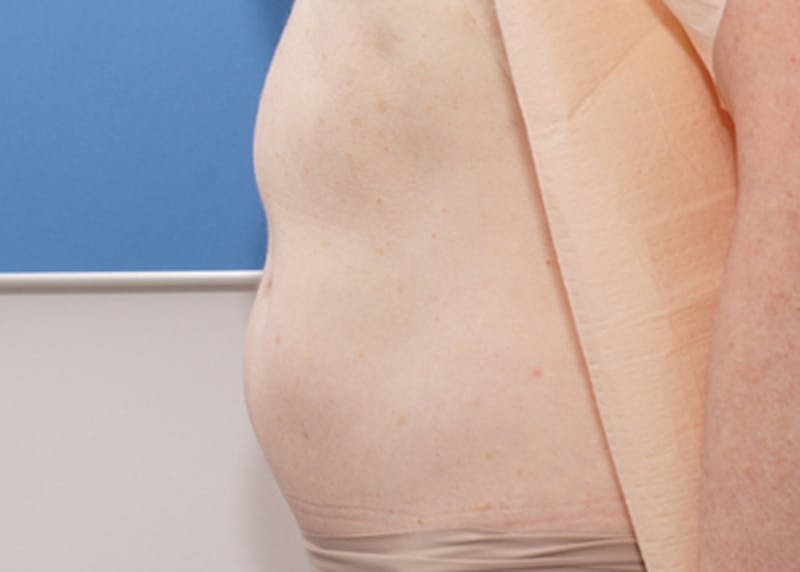 Liposuction (Body) Before & After Gallery - Patient 352394 - Image 11