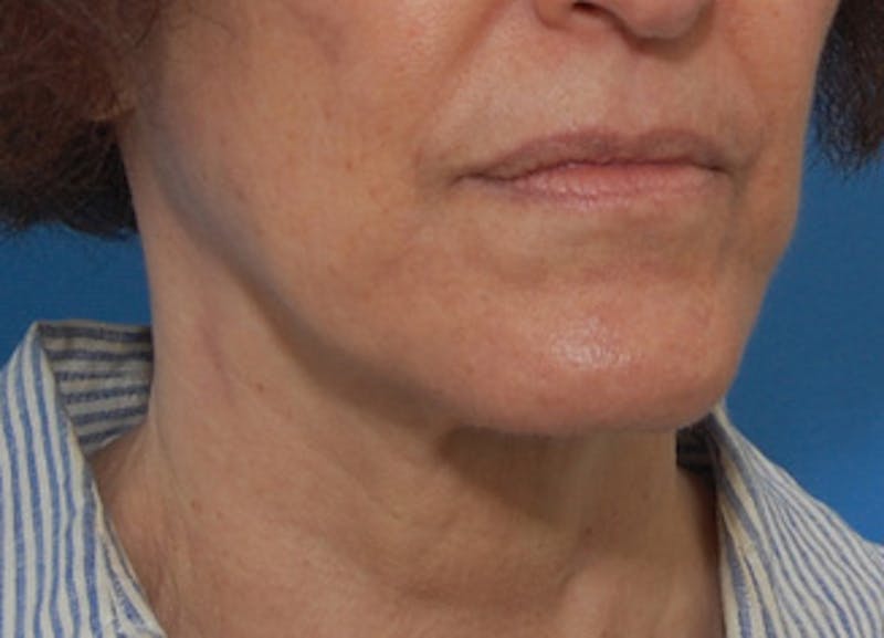Facelift Before & After Gallery - Patient 119743 - Image 6