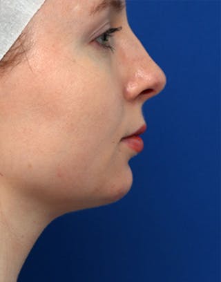 Chin Surgery Before & After Gallery - Patient 301652 - Image 2