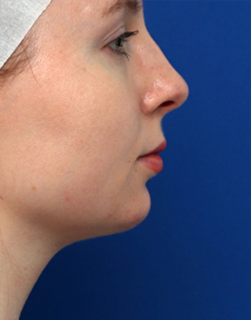 Neck Liposuction Before & After Gallery - Patient 301338 - Image 2