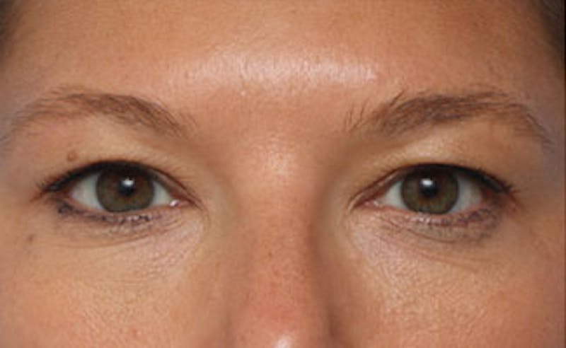 Patient DTkwqmujQ5664UtKoahyBw - Eyelid Surgery Before & After Photos