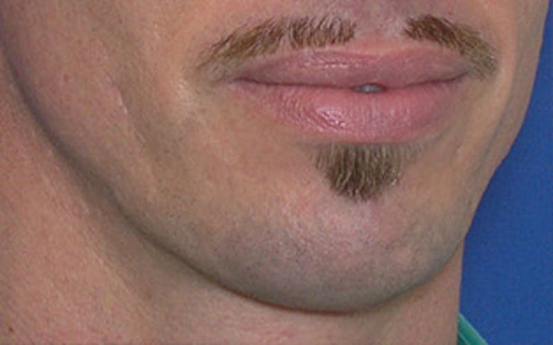 Chin Surgery Before & After Gallery - Patient 346731 - Image 8