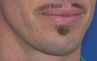 Chin Surgery Before & After Gallery - Patient 346731 - Image 8