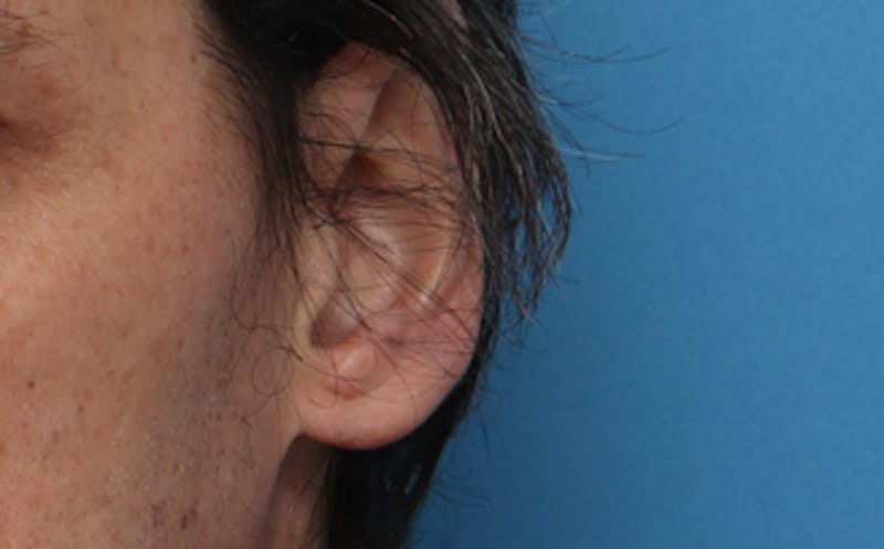 Ear Surgery Before & After Gallery - Patient 113025 - Image 6