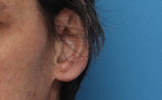 Ear Surgery Before & After Gallery - Patient 113025 - Image 6