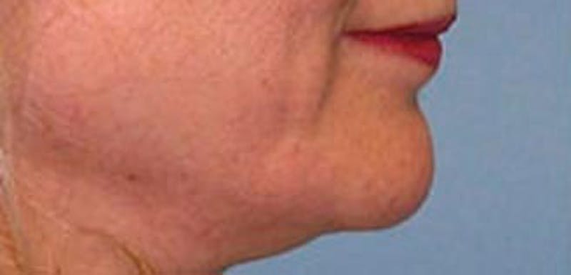 Jawline Contouring Before & After Gallery - Patient 354360 - Image 3