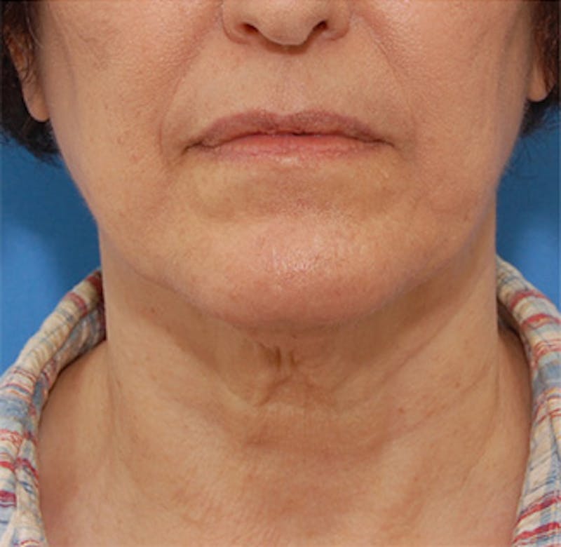 Facelift Before & After Gallery - Patient 119743 - Image 7