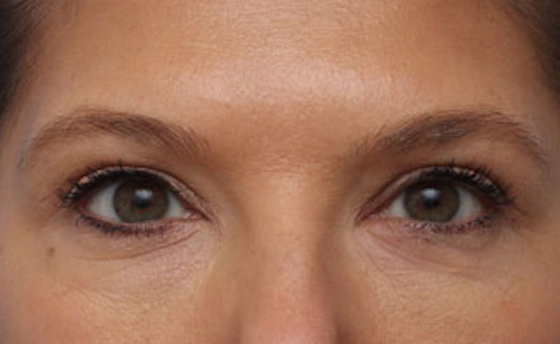 Eyelid Surgery Before & After Gallery - Patient 602784 - Image 2