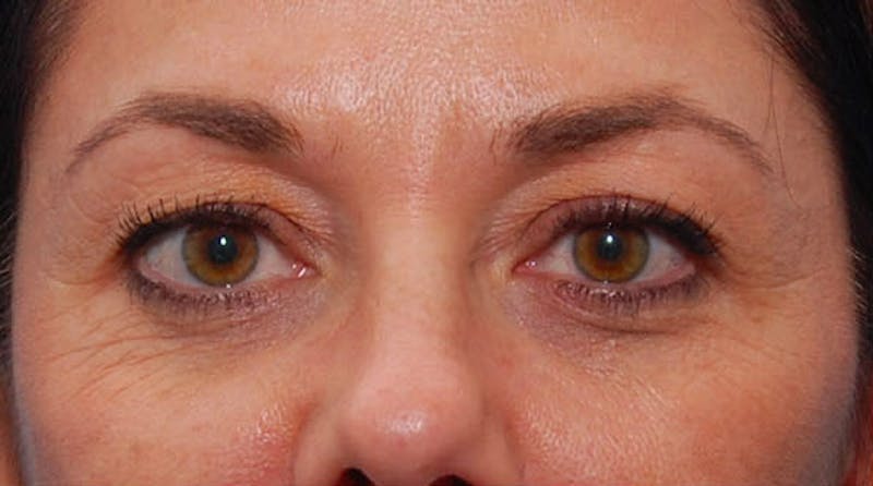 BOTOX Before & After Gallery - Patient 422852 - Image 1