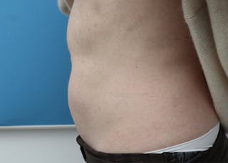 Liposuction (Body) Before & After Gallery - Patient 352394 - Image 12