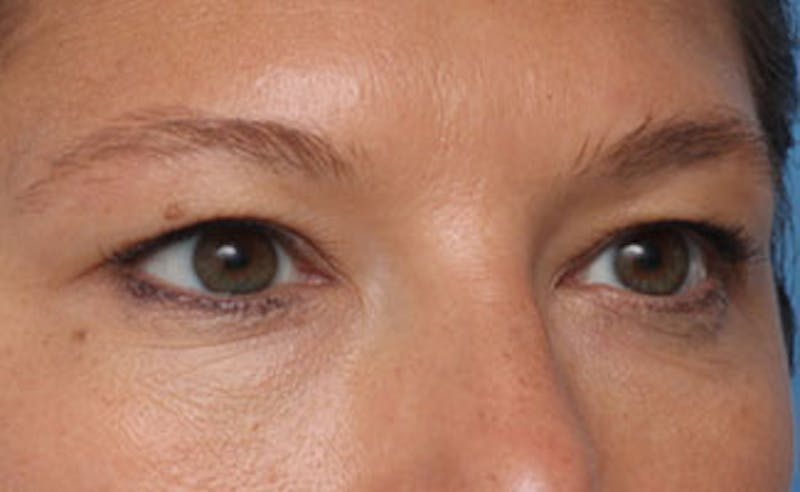 Eyelid Surgery Before & After Gallery - Patient 602784 - Image 3