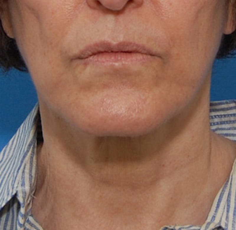 Facelift Before & After Gallery - Patient 119743 - Image 8