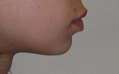 Chin Surgery Before & After Gallery - Patient 388365 - Image 1