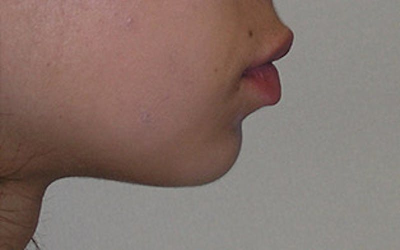 Chin Surgery Before & After Gallery - Patient 388365 - Image 1
