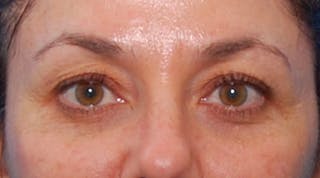BOTOX Before & After Gallery - Patient 422852 - Image 2