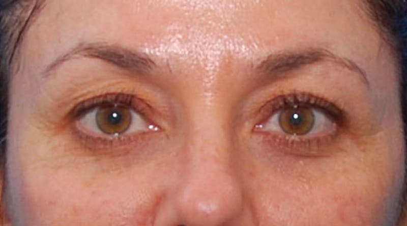BOTOX Before & After Gallery - Patient 422852 - Image 2