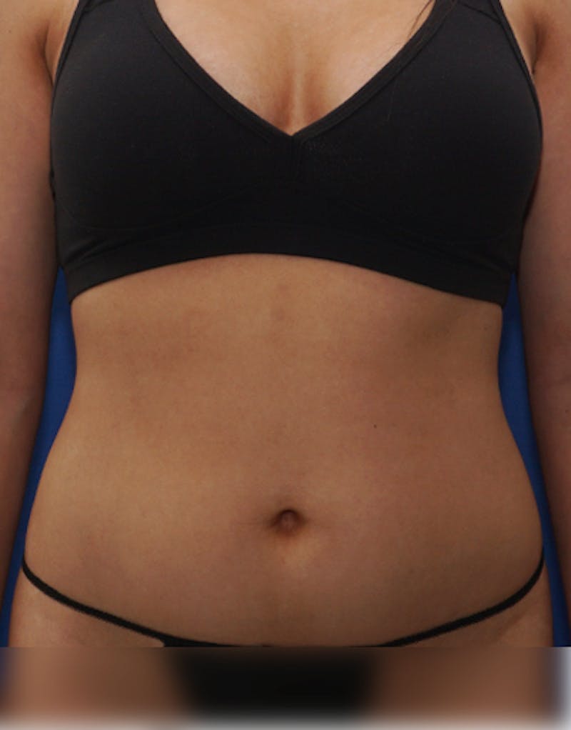 Patient IIeXKfN4R7WcnBTFBB0wFA - Body Liposuction Before & After Photos