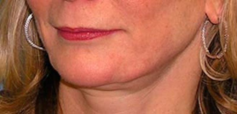 Jawline Contouring Before & After Gallery - Patient 354360 - Image 5