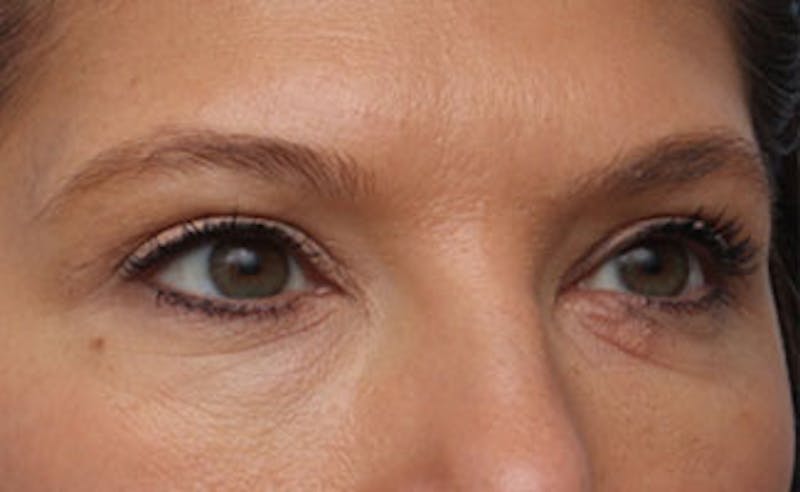 Eyelid Surgery Before & After Gallery - Patient 602784 - Image 4
