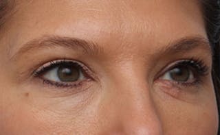 Eyelid Surgery Before & After Gallery - Patient 602784 - Image 4