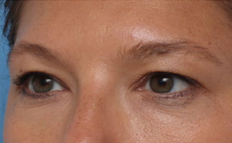 Eyelid Surgery Before & After Gallery - Patient 602784 - Image 5