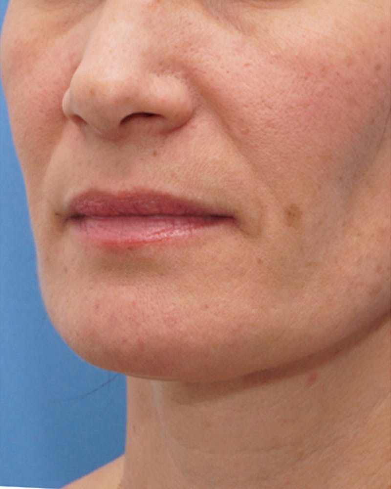 Fillers Before & After Gallery - Patient 734058 - Image 1
