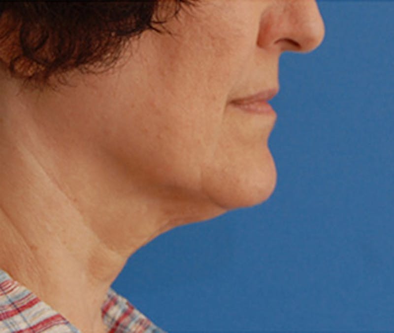 Facelift Before & After Gallery - Patient 119743 - Image 9
