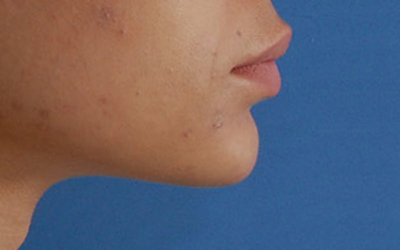 Chin Surgery Before & After Gallery - Patient 388365 - Image 2