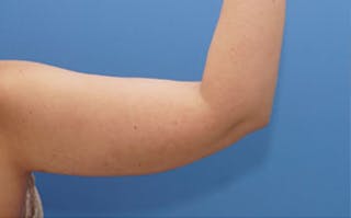 BodyTite Before & After Gallery - Patient 195343 - Image 6