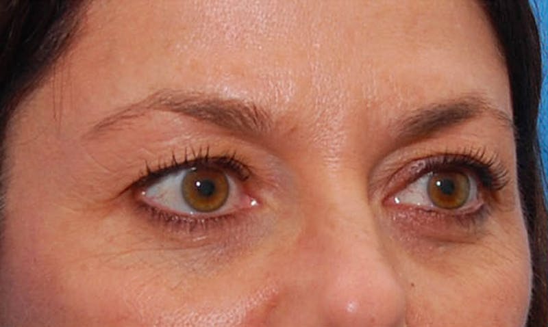BOTOX Before & After Gallery - Patient 422852 - Image 3