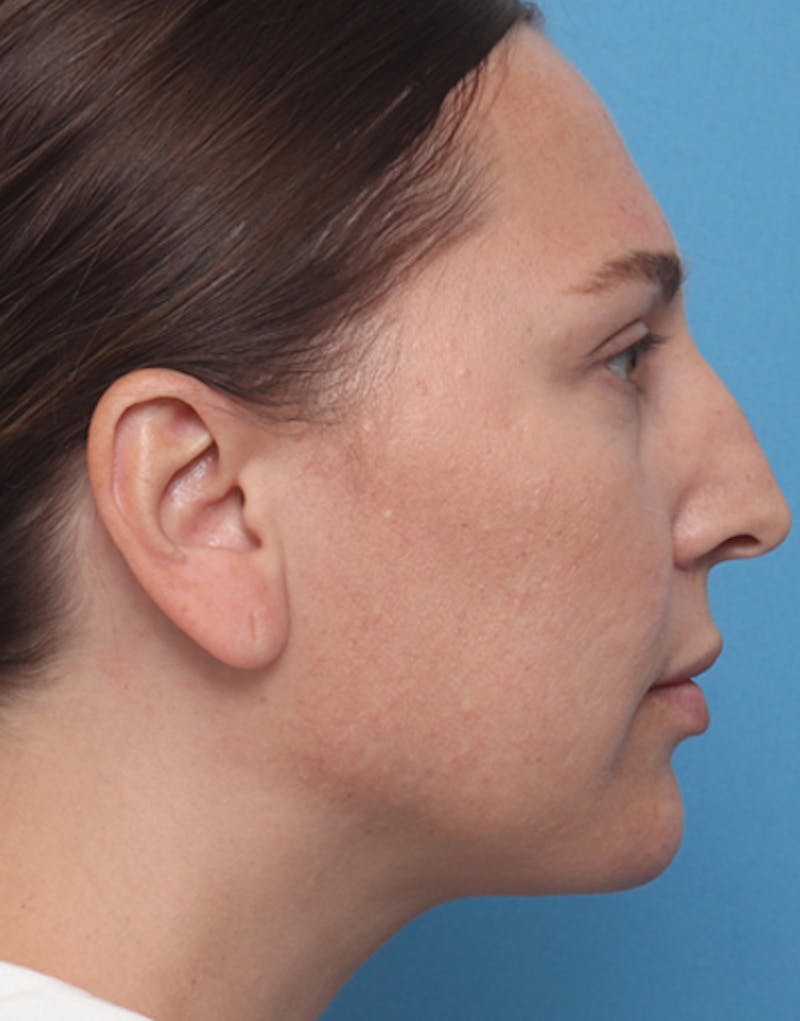 Ear Surgery Before & After Gallery - Patient 329322 - Image 1