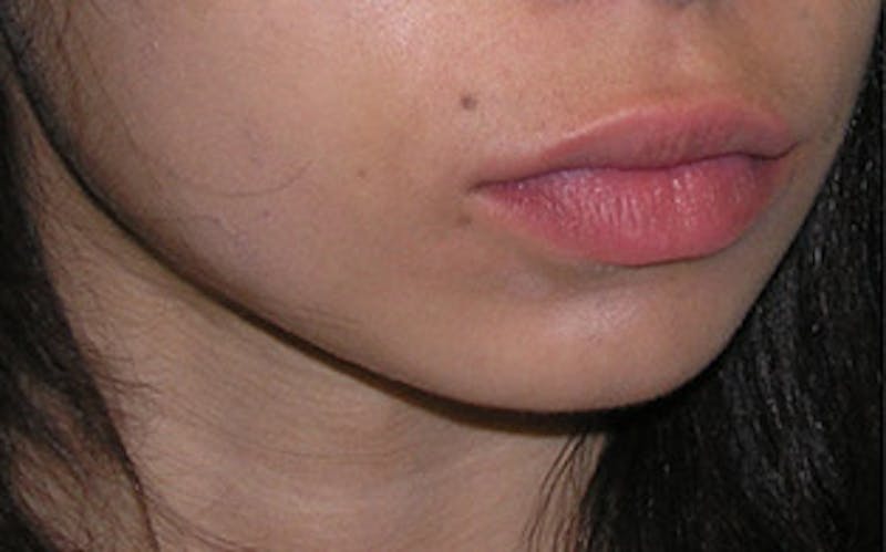 Chin Surgery Before & After Gallery - Patient 388365 - Image 3