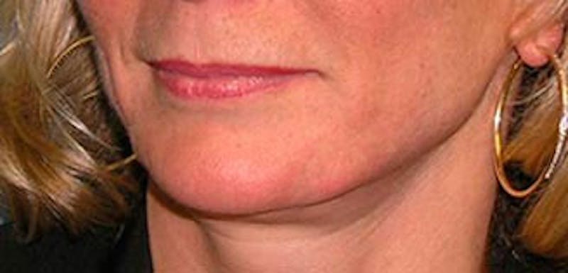 Jawline Contouring Before & After Gallery - Patient 354360 - Image 6