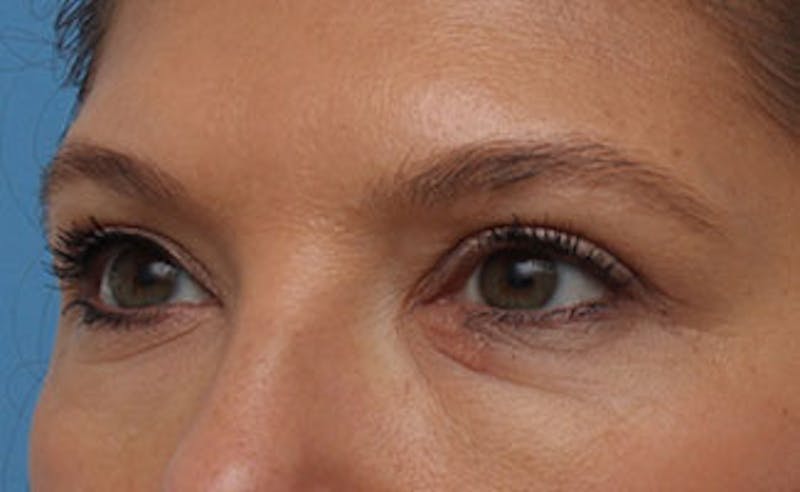 Eyelid Surgery Before & After Gallery - Patient 602784 - Image 6