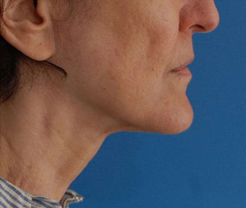 Facelift Before & After Gallery - Patient 119743 - Image 10