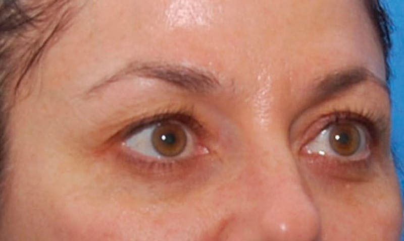 BOTOX Before & After Gallery - Patient 422852 - Image 4