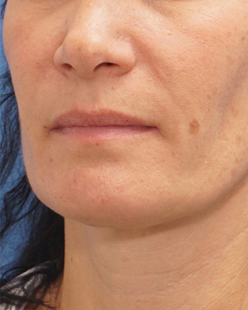 Fillers Before & After Gallery - Patient 734058 - Image 2