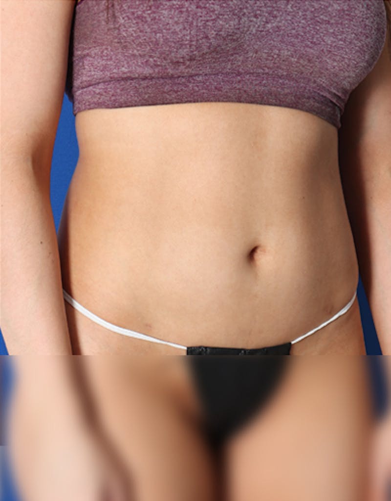 Liposuction (Body) Before & After Gallery - Patient 255887 - Image 3