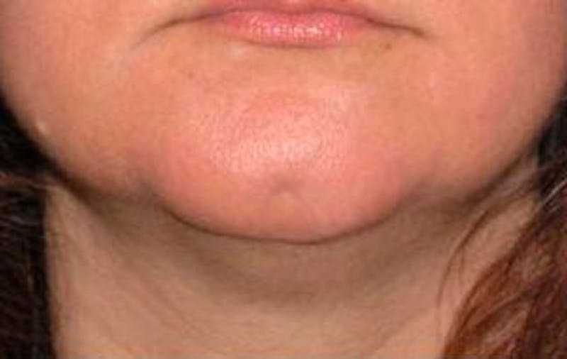 Jawline Contouring Before & After Gallery - Patient 121031 - Image 1