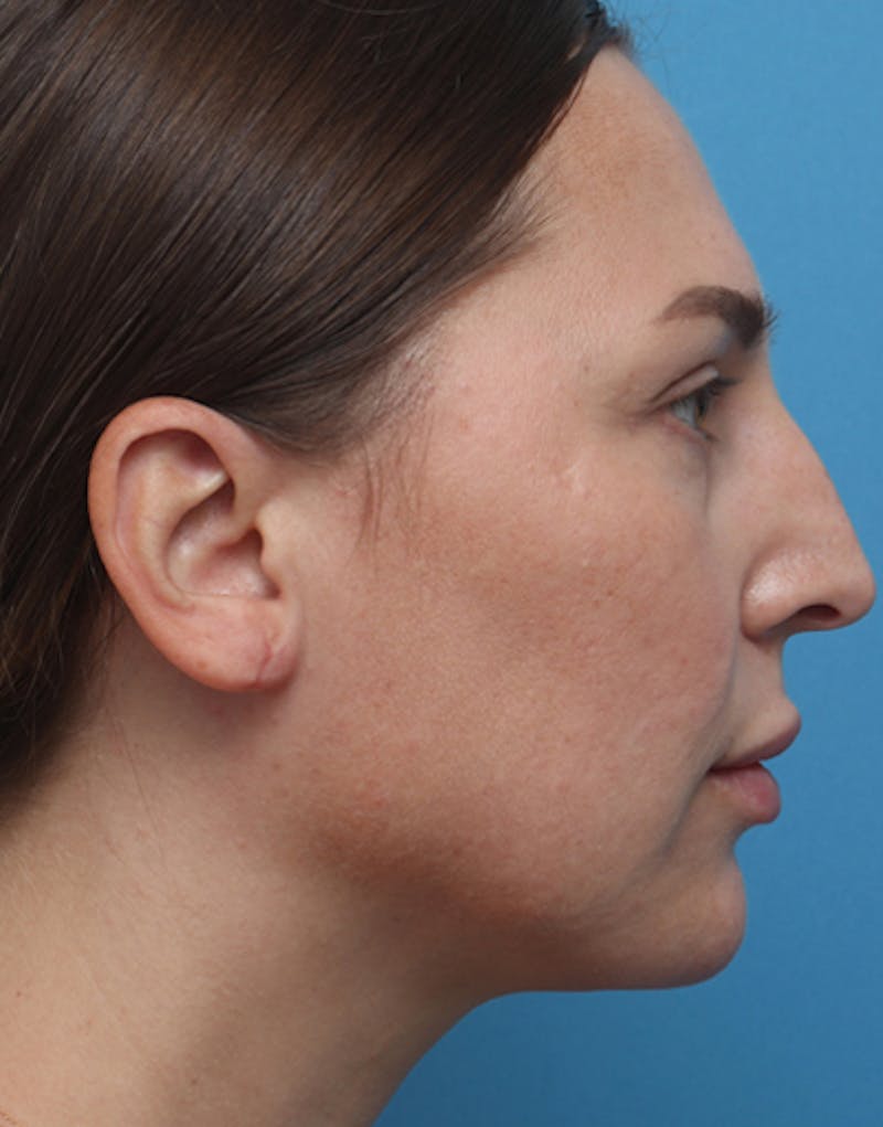 Ear Surgery Before & After Gallery - Patient 329322 - Image 2