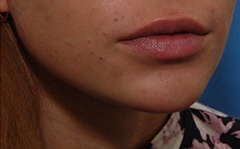Chin Surgery Before & After Gallery - Patient 388365 - Image 4